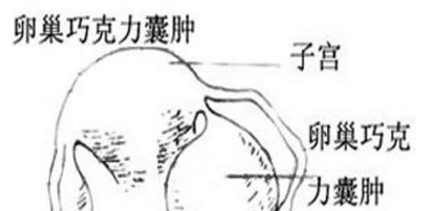 巧克力囊肿能做试管婴儿吗