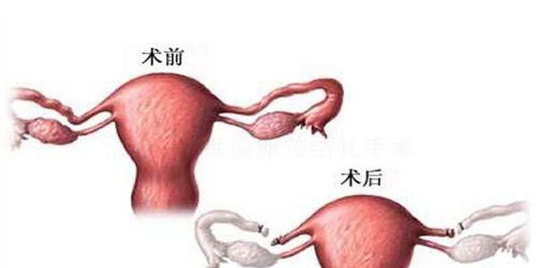 做了输卵管结扎能做试管婴儿吗-答案是肯定的