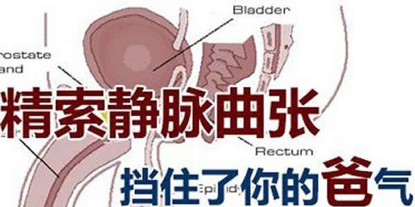 男性患精索静脉曲张会引起不孕吗