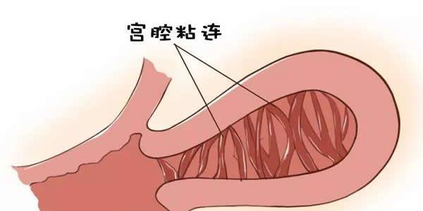 专家来告诉你-轻度宫腔粘连可以自愈吗