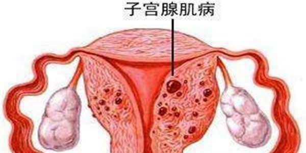 腺肌症还能做试管婴儿吗