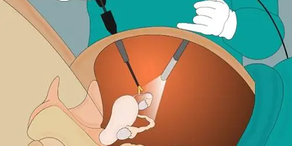轻度宫腔粘连做试管能成功吗-专家分析
