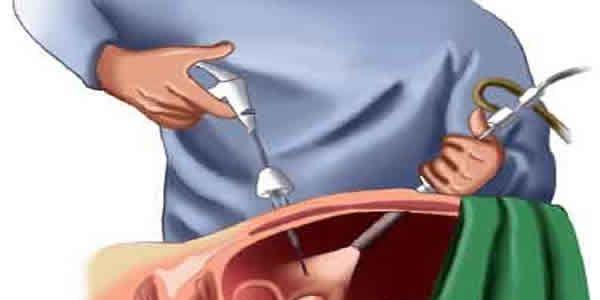 腹腔镜手术治疗