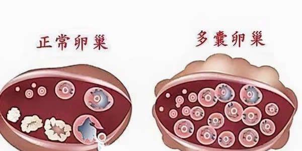 青春期多囊卵巢综合症怎么调理才能好起来