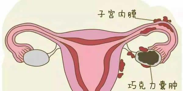 巧克力囊肿
