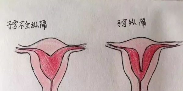 分享临床医师手绘子宫畸形图，让你对畸形子宫的类型过目不忘