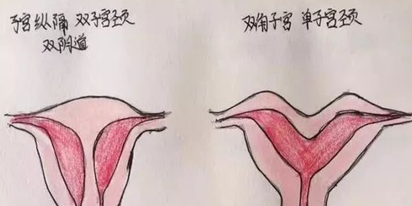 分享临床医师手绘子宫畸形图，让你对畸形子宫的类型过目不忘
