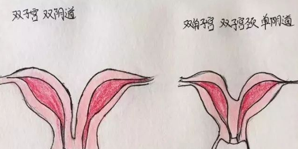 分享临床医师手绘子宫畸形图，让你对畸形子宫的类型过目不忘