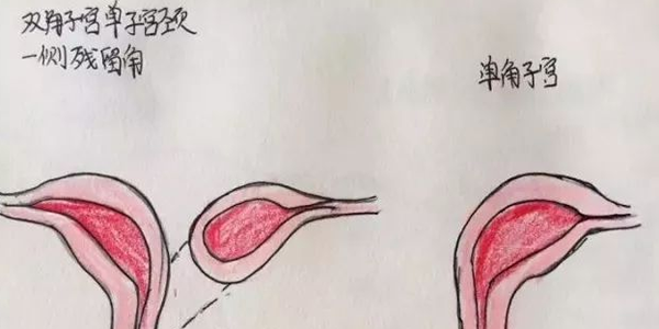 分享临床医师手绘子宫畸形图，让你对畸形子宫的类型过目不忘
