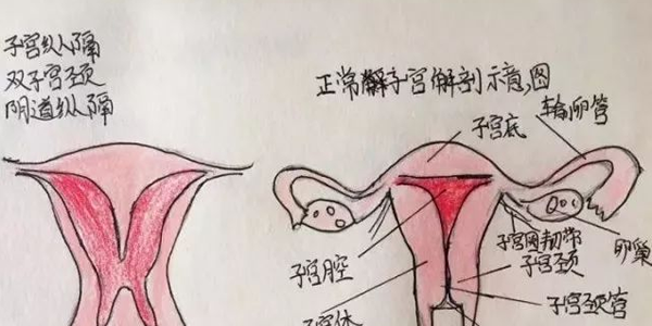 分享临床医师手绘子宫畸形图，让你对畸形子宫的类型过目不忘