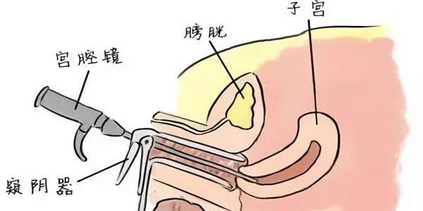 盘点女性宫腔粘连的4大治疗方法-患者一定要了解