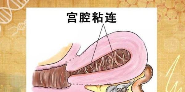 盘点引发宫腔粘连的4大因素-建议女性都要了解 盘点引发宫腔粘连的4大因素-建议女性都要了解