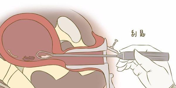 盘点引发宫腔粘连的4大因素-建议女性都要了解 盘点引发宫腔粘连的4大因素-建议女性都要了解