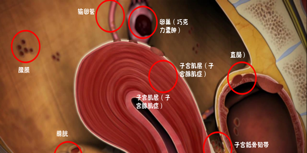 下列关于内异症的病理特点及4大常见病因建议收藏后了解