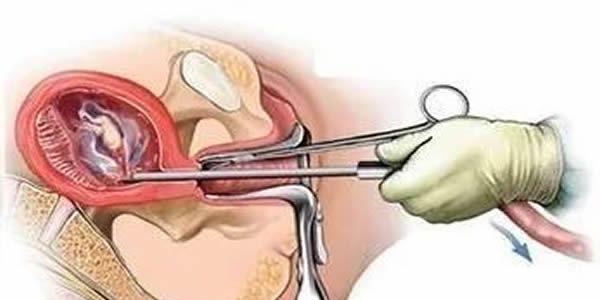 宫腔粘连的病理检查项目-三个检查可确诊 宫腔粘连的病理检查项目-三个检查可确诊