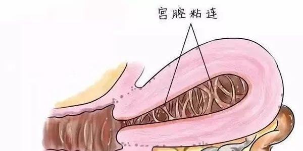 宫腔粘连分离术后需要注意什么事项才不会出现复粘的情况
