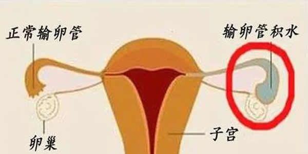 输卵管积水可以直接做试管婴儿吗
