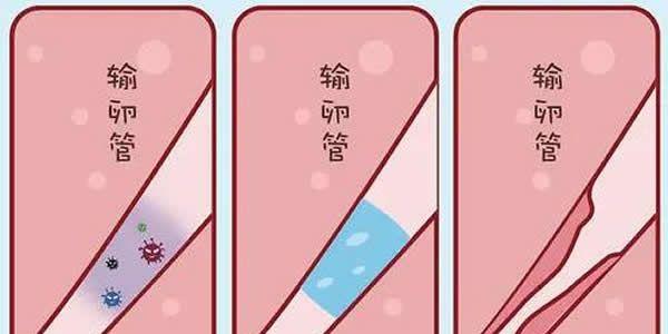 输卵管积水可以直接做试管婴儿吗
