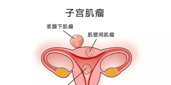 子宫肌瘤试管能成功吗