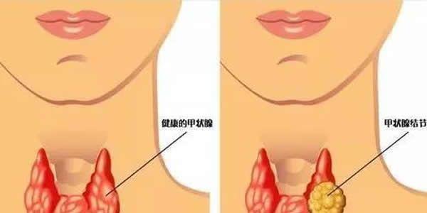 甲状腺有问题会影响怀孕吗