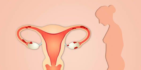 出现子宫内膜异位症后常见的5大症状-女性可自查