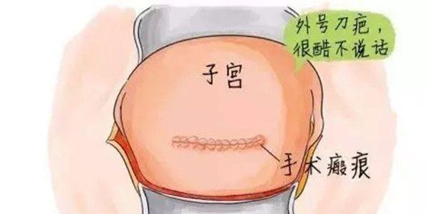 瘢痕子宫怀孕生二胎的注意事项    