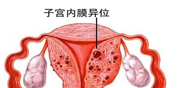 子宫内膜异位症会影响女性怀孕吗