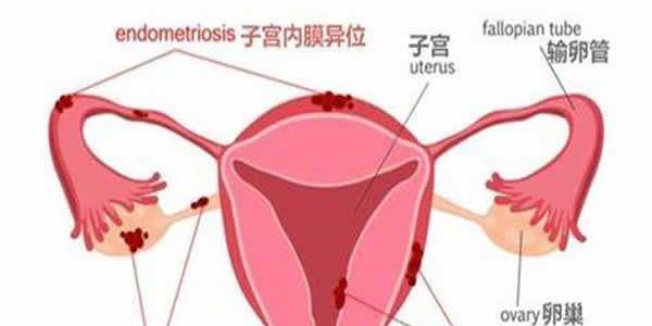 子宫内膜异位症会影响女性怀孕吗