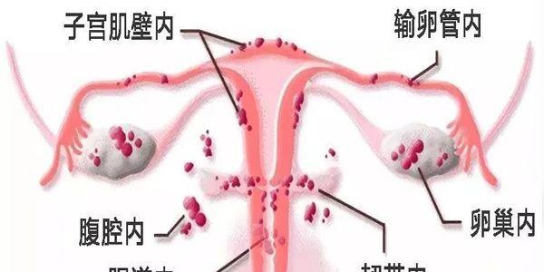 子宫内膜异位症会影响女性怀孕吗