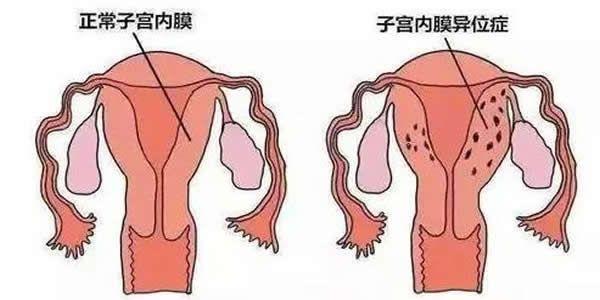 谈谈子宫内膜异位症与不孕的关系