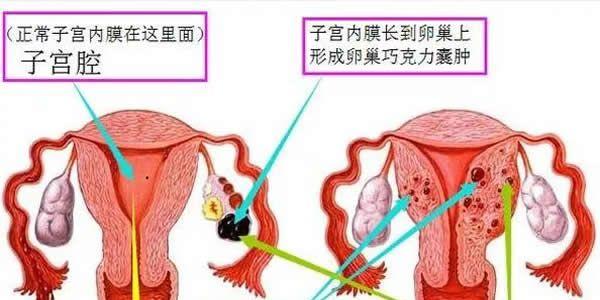 谈谈子宫内膜异位症与不孕的关系