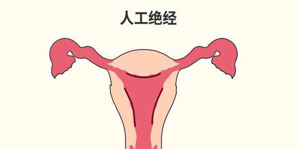 人工绝经