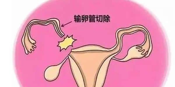 两侧输卵管切除还能做试管生育吗