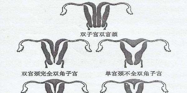 子宫畸形会导致不孕不育