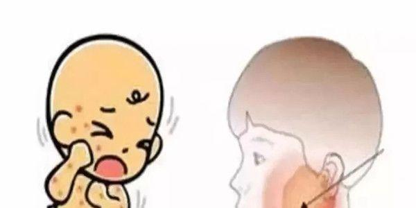 听说小时候腮腺炎会影响生育，是真的吗？