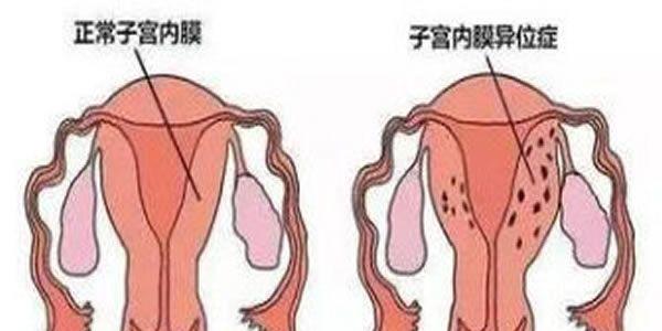 子宫内膜异位症能做试管婴儿吗？成功率高吗？
