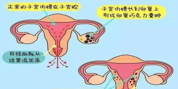 子宫内膜异位症能做试管婴儿吗？成功率高吗？