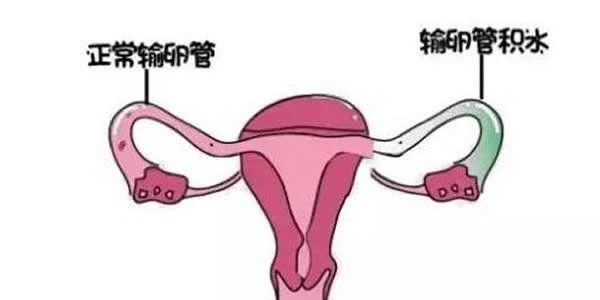输卵管积水图