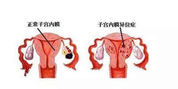 子宫内膜异位症