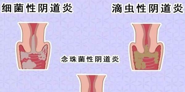 阴道炎症问题