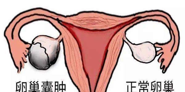 卵巢囊肿