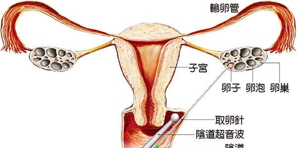 取卵