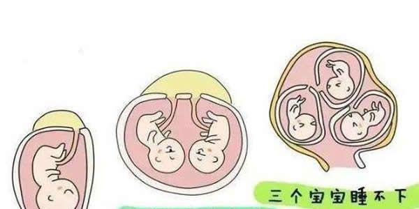 试管什么情况下需要减胎