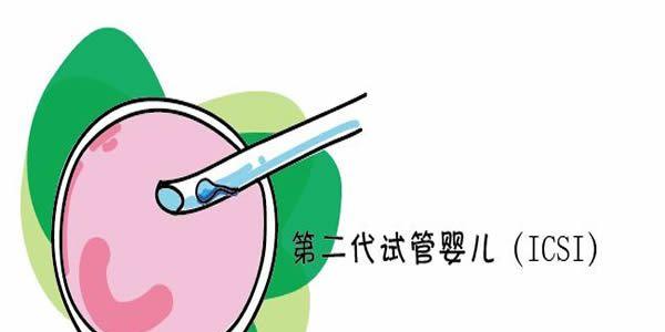 第二代试管婴儿