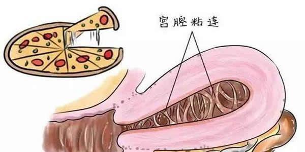 宫腔粘连的症状有哪些