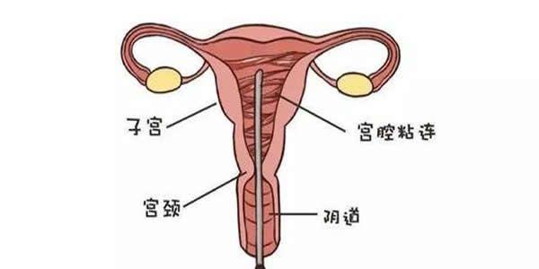 宫腔粘连的症状有哪些