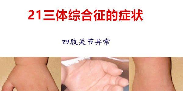 带你了解21三体综合征的危害