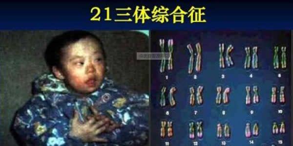 带你了解21三体综合征的危害