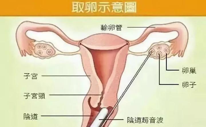 泰国第三代试管婴儿详细流程图解