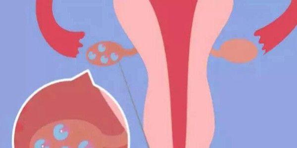 什么是卵巢过度刺激综合征，要如何治疗